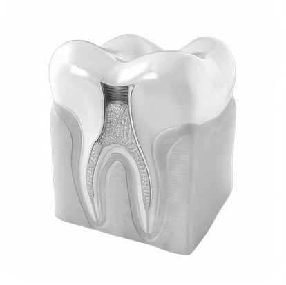 Лечение корневых каналов